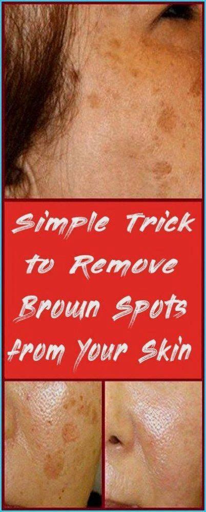 simple trick to remove brown spots from your skin in 2020 skin herbal brown spots on face