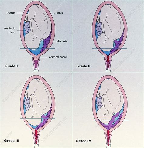 Grades Of Placenta Praevia Stock Image C0252602 Science Photo