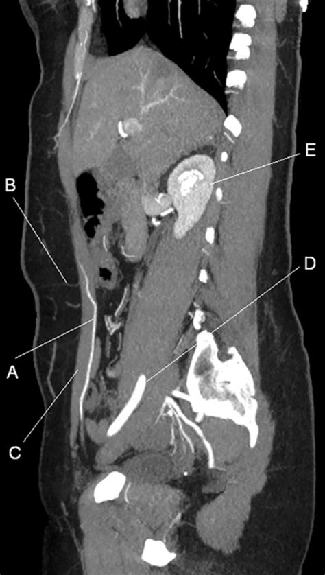 Sagittal Section Abdomen
