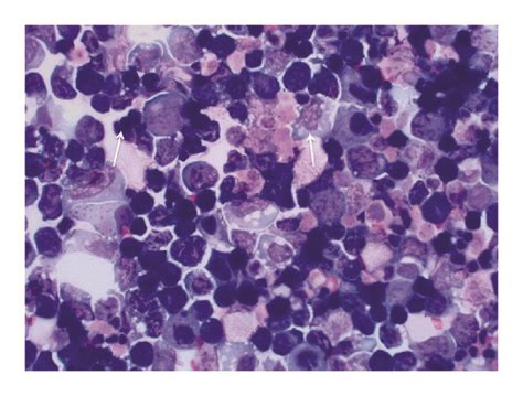 Ascitic Fluid Cytology With Diff Quick Stain Demonstrating Large