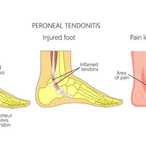 Peroneal Tendon Injuryoveruse Causes Symptoms And Treatment Dr Foot