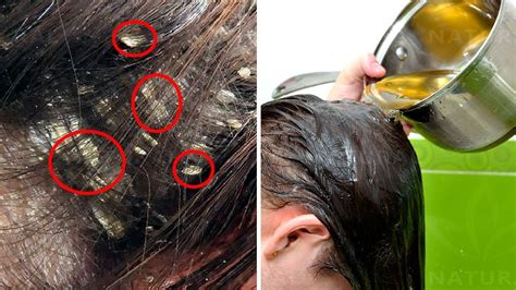 3 Home Remedies To Get Rid Of Dandruff Naturally Youtube