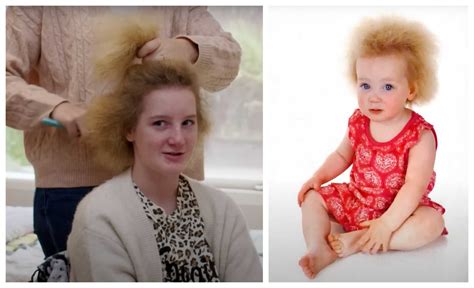 Girl With Uncombable Hair Syndrome Speaks Up