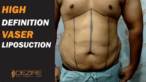 Hi Def Vaser Liposuction Of Flanks Lower Back Abdomen 6 Pack Abs Creation Surgery Youtube