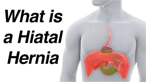 Whats The Difference Between A Hernia And A Hiatal Hernia Top Answer