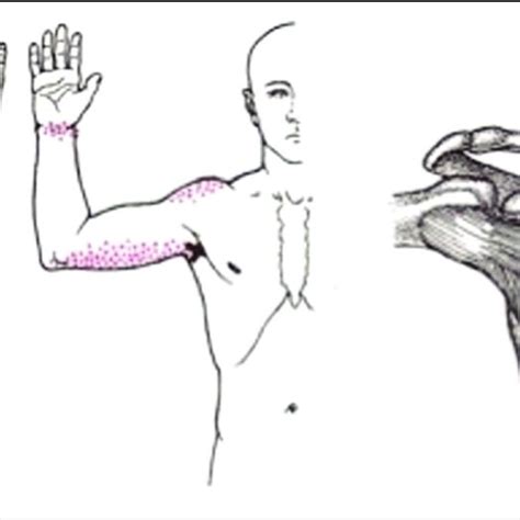 Subscapularis Trigger Points Xs And Projected Referral Pain Pattern
