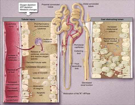 1 Illustration Showing The Mechanisms Of Acute Tubular Necrosis The