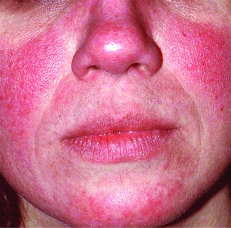 Ivermectin Rosacea Pdf New Indications For Topical Ivermectin 1 Cream