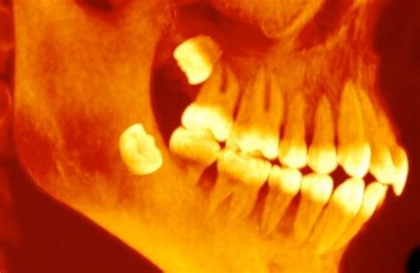 Why Do Humans Still Have Wisdom Teeth Evolution Explains