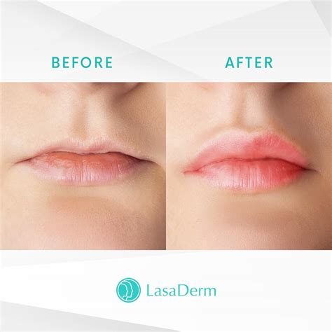 teosyal kiss lip filler success story lasaderm