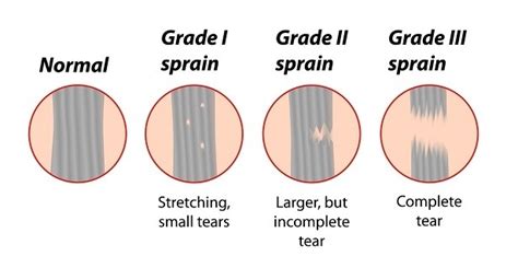 Strains Vs Sprains Whats The Difference Myphysiosa