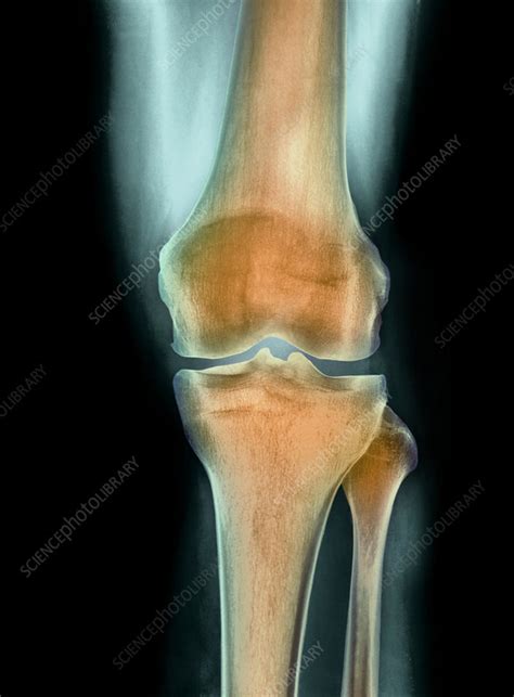 Healthy Knee X Ray Stock Image P1160747 Science Photo Library