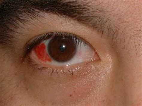 Subconjunctival Hemorrhage Causes Symptoms Diagnosis And Treatment