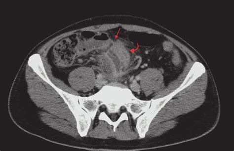 The Fistula Between Abscess Cavity And Sigmoid Colon In The Patient