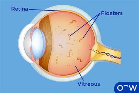 Eye Floaters Definition Causes Symptoms And Treatment