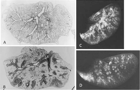 Mycoplasma Pneumonia X Ray Findings
