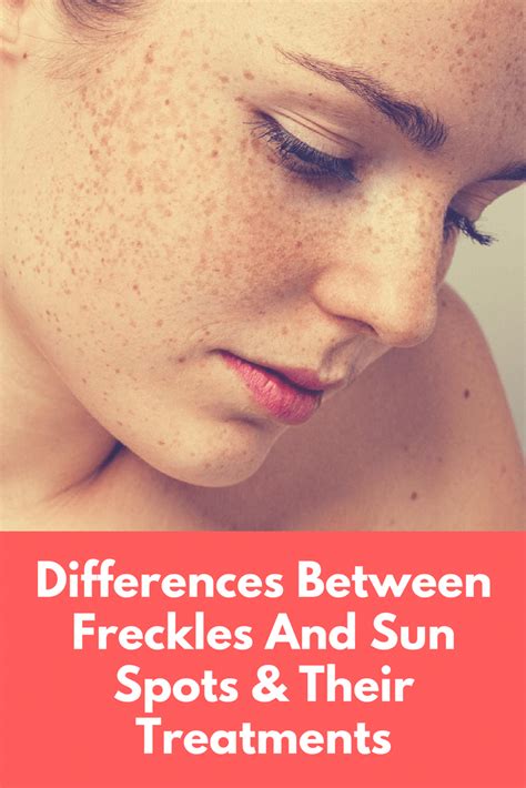 Freckles Vs Sunspots And Treatment Dubai Cosmetic Surgery® Freckles Treatment Laser Skin