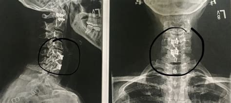 How Anterior Cervical Disk Fusion Surgery Improved My Life Patients