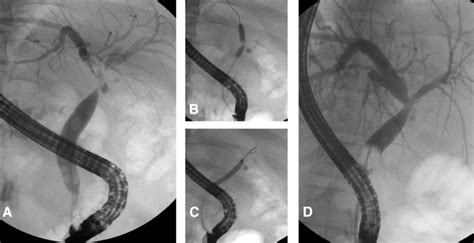 Optimized Endoscopic Treatment Of Ischemic Type Biliary Lesions After