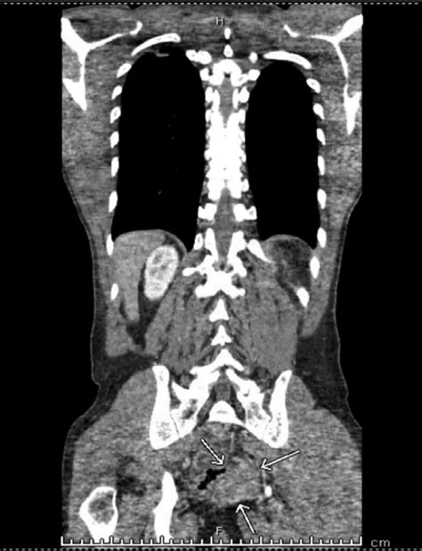 Ct Abdomen And Pelvis With Iv Contrast Showing Cm Enhancing