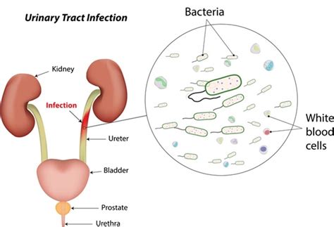 Urinary Tract Infections In Children