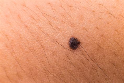 Best Way To Beat Melanoma Is To Know The Symptoms Health Essentials