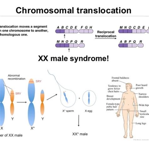 Schemaac View Of The Y Sex Chromosome Where The Sry Geneis Located In