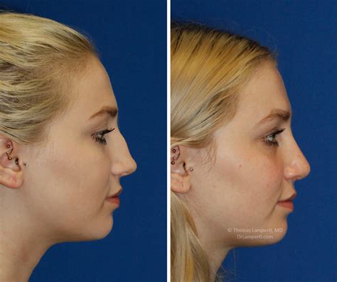 Before And After Saddle Nose And Hump Removal Rhinoplasty Seattle