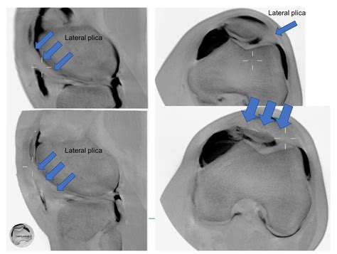 Cbct Of Knee Cartilagehelp