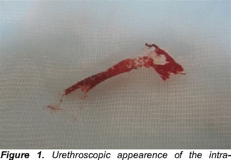 Figure 1 From A RARE COMPLICATION OF TENSION FREE VAGINAL TAPE