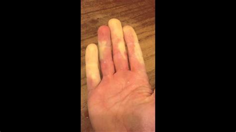 Raynauds Syndrome In Real Time Youtube