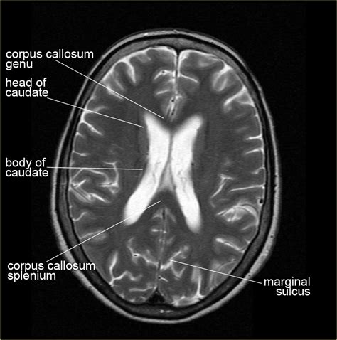 Brain Lobe Anatomy Mri