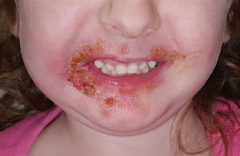 Mild Perioral Dermatitis Lips