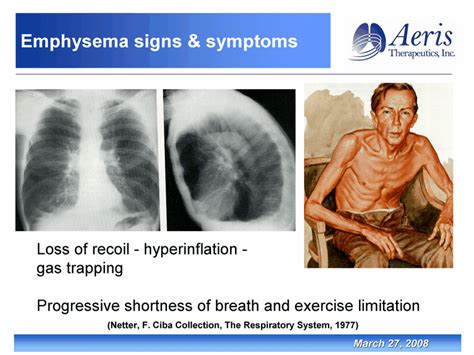 Emphysema Signs And Symptomsloss Of Recoil Hyperinflation Gas