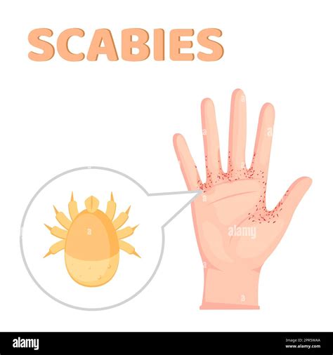 Scabies Contagious Skin Infestation Scabies Mite And Humans Skin