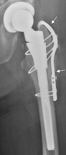 Periprosthetic Femoral Fractures In The Emergency Department What The