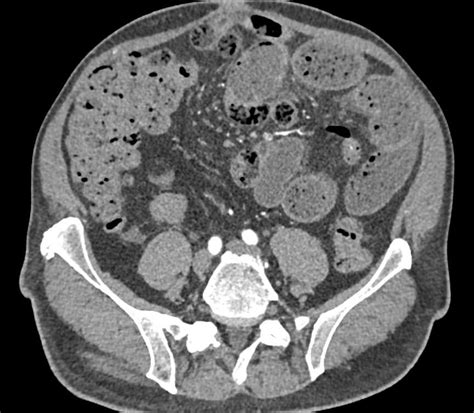Small Bowel Obstruction Sbo Due To Adhesions Small Bowel Case