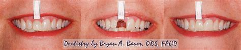 This didn't come cheap at an average price of $2,400. Wheaton Dental Implants | Dental Implants video | Bauer Smiles