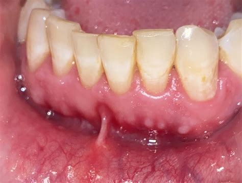 Hard White Bumps On Gums Should I Be Worried R Medical Advice