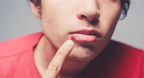 Cold Sores Pictures Symptoms Causes And Treatments