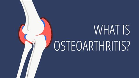 Osteoarthritis Explained In Under 2 Minutes Goodrx