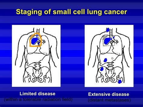 Small Cell Lung Cancer Sclc