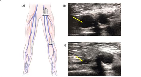 Femoral And Popliteal Vein Pocus A The Illustration Shows The Two Download Scientific Diagram