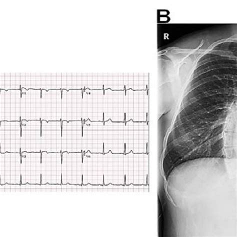Electrocardiography And Chest Radiography At The Initial Admission