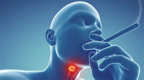Throat Cancer Wetin Be Di Causes And Signs Of Throat Cancer Bbc