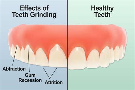 Fact Sheet Teeth Grindingbruxism