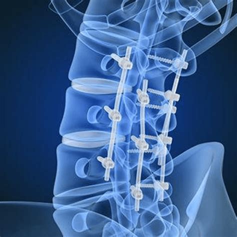 Spinal Fusion Surgery In Delhi Solutions To Spine Problems Dr Amit Chugh