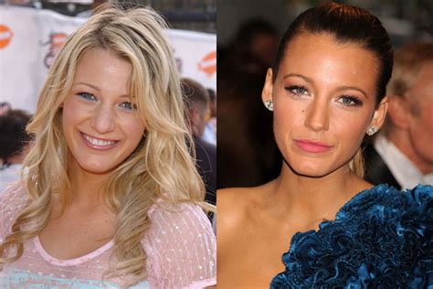 Blake Lively Nose Job Before And After