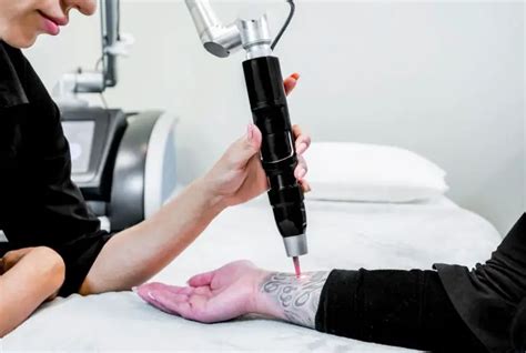 Best Lasers For Tattoo Removal Reviews And Buying Guide 2023