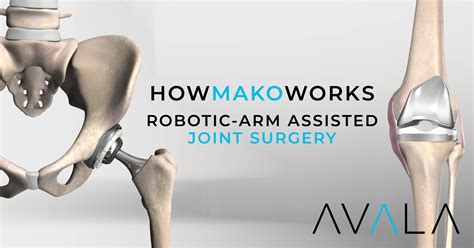 How Mako Robotic Arm Assisted Surgery Works Avala